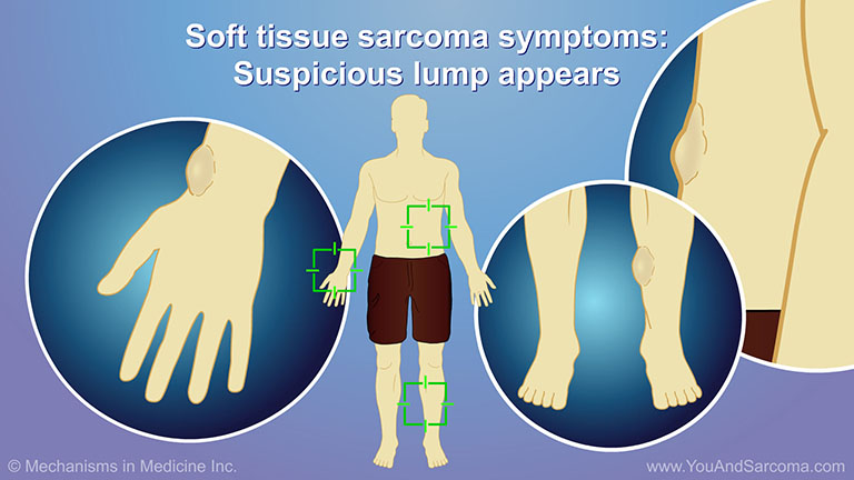 Diagnosing and Treating Soft Tissue Sarcoma