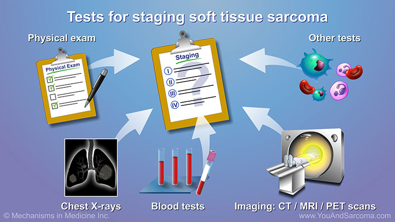 Diagnosing and Treating Soft Tissue Sarcoma
